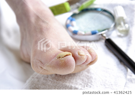 Onychomycosis, nail disease caused by fungi 41362425