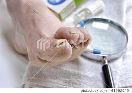 Onychomycosis, nail disease caused by fungi Onychomycosis, nail disease caused by fungi 41362949