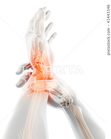 Wrist painful - skeleton x-ray. Wrist painful - skeleton x-ray. 41443346