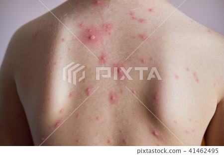 Little girl with chickenpox Little girl with chickenpox 41462495