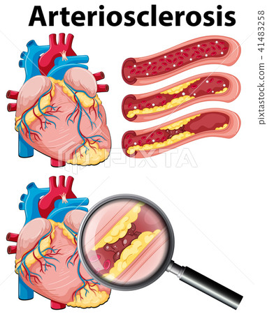 A Heart with Arteriosclerosis on White Background 41483258