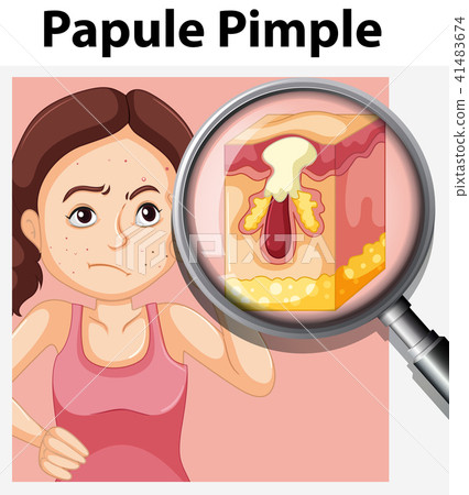 A Papule Pimple on Teenager Face A Papule Pimple on Teenager Face 41483674