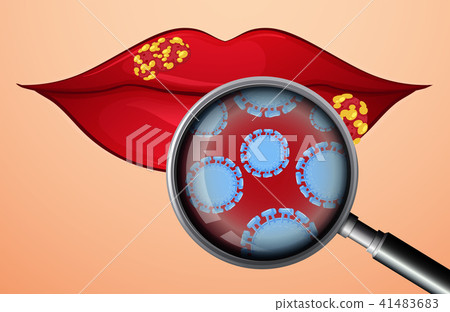 A Lip with Herpes Virus A Lip with Herpes Virus 41483683