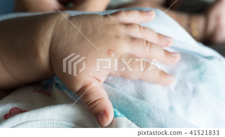 Baby have mosquito bite on skin and have mark Baby have mosquito bite on skin and have mark 41521833