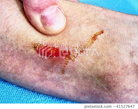 First-aid at bloody wound, leg with red spot sore 41527647
