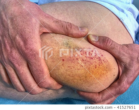 Injured adult body with large paintful hematoma. Injured adult body with large paintful hematoma. 41527651