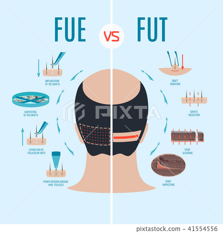 FUE and FUT hair loss treatment FUE and FUT hair loss treatment 41554556