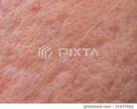 closeup skin problems, nodular cystic acne skin 41637682