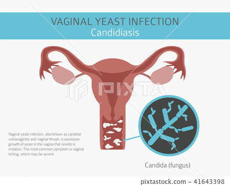 Vaginal yeast infection. Ginecological infographic 41643398