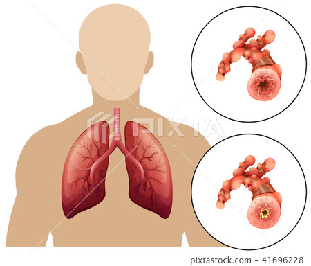 Human Chronic Obstructive Pulmonary Disease 41696228