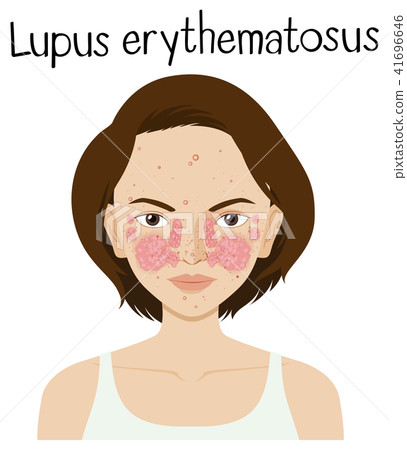 A Vector of Lupus Erythematosus 41696646
