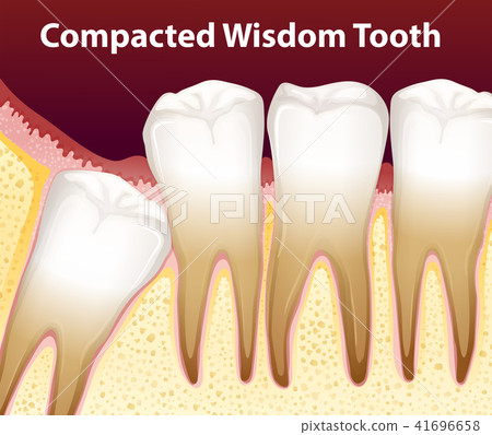 A Compacted wisdom tooth 41696658