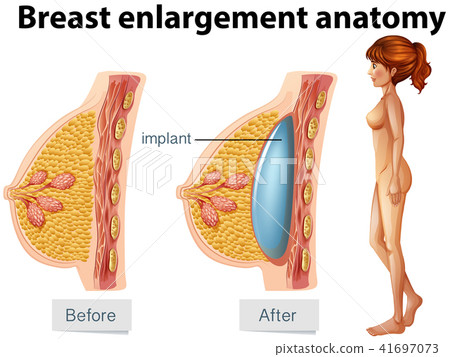 A Human Anatomy of Breast Implant Stock Illustration 41697073