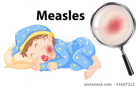 A Vector of Measles on Baby Face A Vector of Measles on Baby Face 41697322