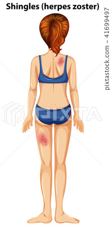 Women with shingles herpes zoster 41699497