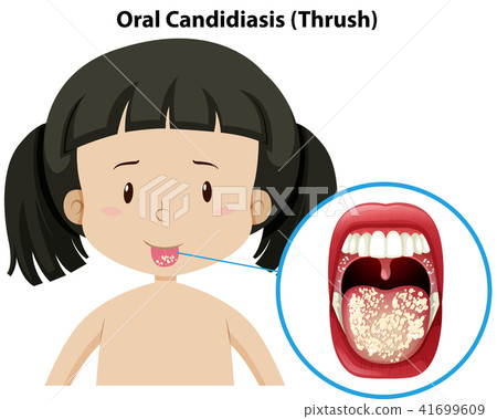 Oral Candidiasis thursh on girl 41699609