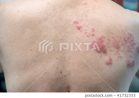 Shingles (Disease), Herpes zoster 41732355