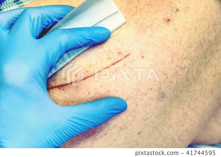 Postoperative scar of joint surgery.Detail of skin 41744595