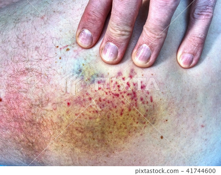 Bruised wound injury on human body. Patient show Bruised wound injury on human body. Patient show 41744600
