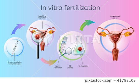 In Vitro Fertilization Procedures Vector Scheme 41782102