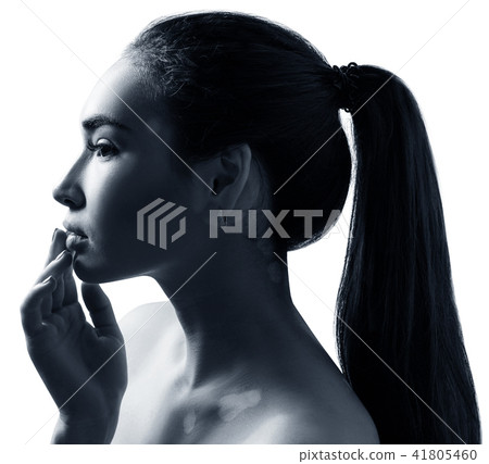 Portrait of beautiful woman with vitiligo. Portrait of beautiful woman with vitiligo. 41805460