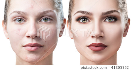 Woman with acne before and after treatment and make-up. 41805562