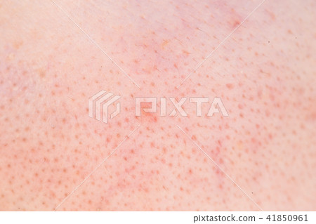 close up of black head 41850961