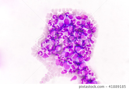Immature blood cells in leukemia. 41889185