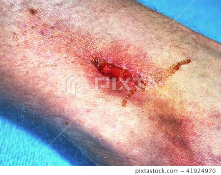 Fresh affected bloody skin.  Deep scratches 41924970