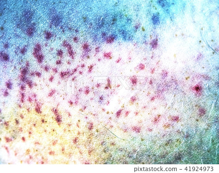 Patient show body with large paintful hematoma. 41924973