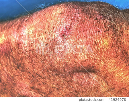 Leg after cosmetic or plastic procedure. Leg after cosmetic or plastic procedure. 41924978