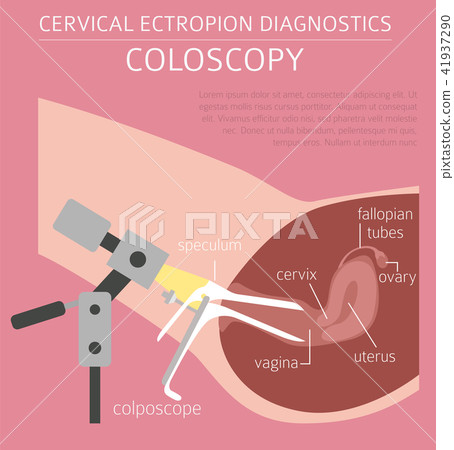 Cervical ectropion. Ginecological infographic Cervical ectropion. Ginecological infographic 41937290