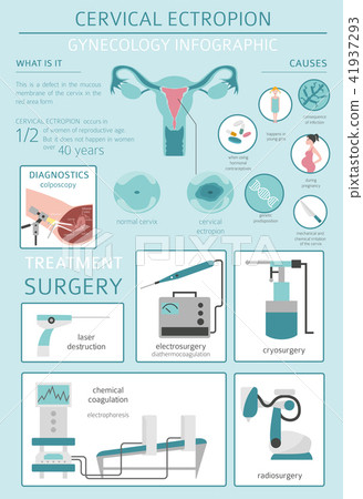 Cervical ectropion. Ginecological infographic Cervical ectropion. Ginecological infographic 41937293