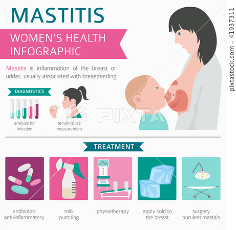 Mastitis Breastfeed Medical Infographic Stock Illustration 41937311 Pixta