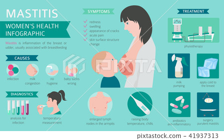 Mastitis Breastfeed Medical Infographic Stock Illustration 41937313 Pixta