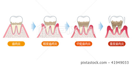 Progression of periodontal disease Progression of periodontal disease 41949033