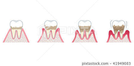 Progression of periodontal disease 41949083