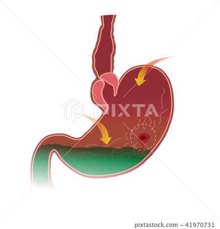stomach peptic ulcer stomach peptic ulcer 41970731
