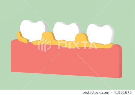 tooth periodontal disease with dental plaque 41991673