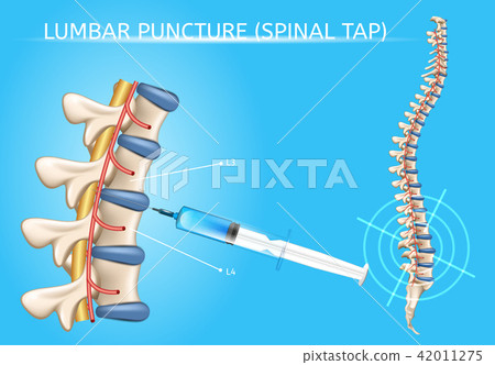 Lumbar Puncture Realistic Vector Medical Scheme Lumbar Puncture Realistic Vector Medical Scheme 42011275