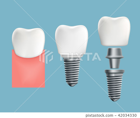 infographics of human teeth and dental implant 42034330
