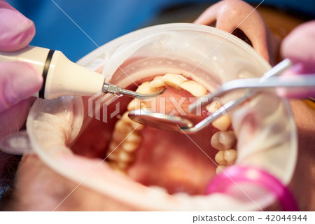 Examination of patient with tartar in clinic with innovative technologies Examination of patient with tartar in clinic with innovative technologies 42044944