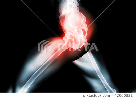 Hip painful skeleton x-ray, 3D illustration. 42060821
