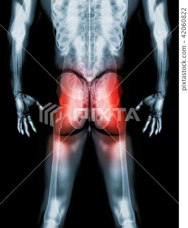 Hip painful skeleton x-ray, 3D illustration. 42060822