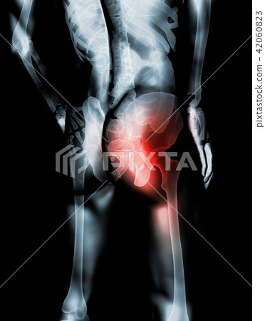 Hip painful skeleton x-ray, 3D illustration. Hip painful skeleton x-ray, 3D illustration. 42060823