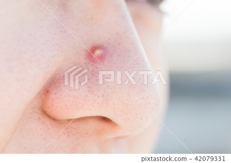 close up of facial acne 42079331