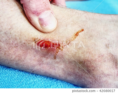Doctors hand healing a burned skin area. 42080017