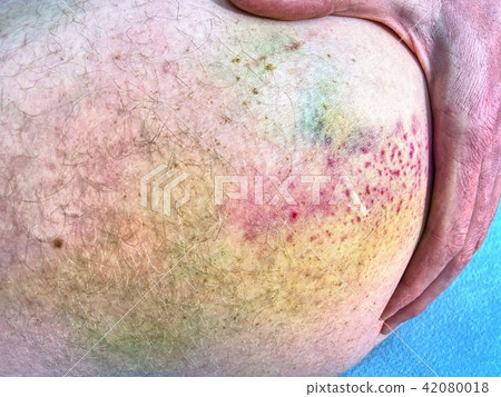 Large colorful bruise on body. Painful hurt place 42080018
