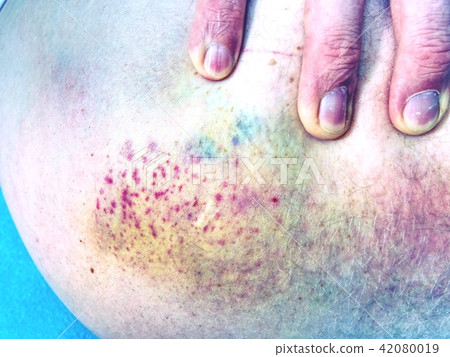 Hand embracing injured leg with painful hematoma 42080019