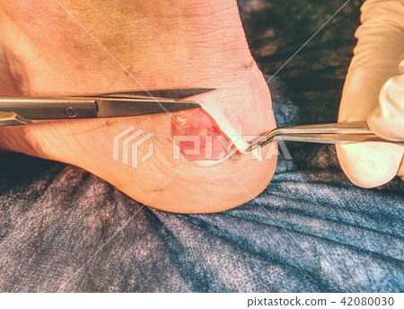 Doctor cut dead skin on leg.  Craced nasty blister 42080030